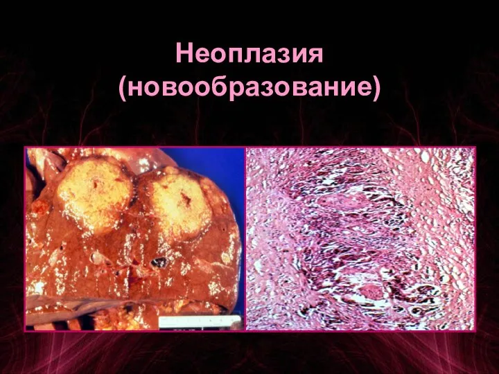 Неоплазия (новообразование)