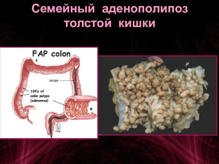 Семейный аденополипоз толстой кишки