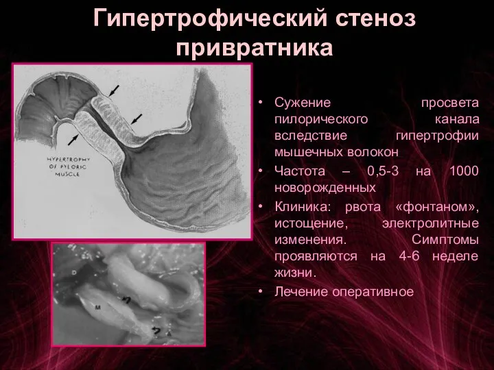 Гипертрофический стеноз привратника Сужение просвета пилорического канала вследствие гипертрофии мышечных волокон
