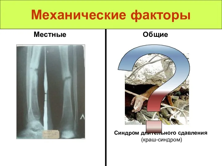 Механические факторы Местные Общие Синдром длительного сдавления (краш-синдром) ?