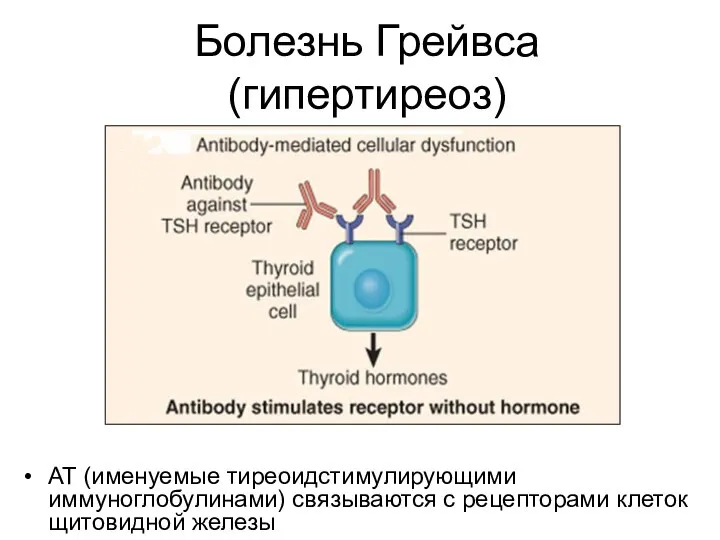 Болезнь Грейвса (гипертиреоз) АТ (именуемые тиреоидстимулирующими иммуноглобулинами) связываются с рецепторами клеток щитовидной железы