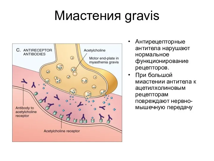 Миастения gravis Антирецепторные антитела нарушают нормальное функционирование рецепторов. При большой миастении