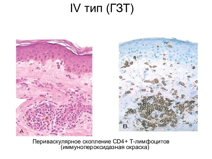 IV тип (ГЗТ) Периваскулярное скопление CD4+ Т-лимфоцитов (иммунопероксидазная окраска)