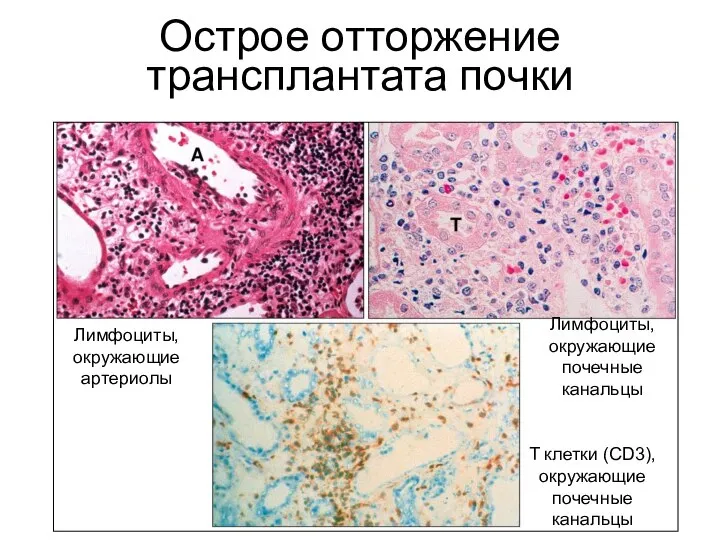 Острое отторжение трансплантата почки T клетки (CD3), окружающие почечные канальцы Лимфоциты,