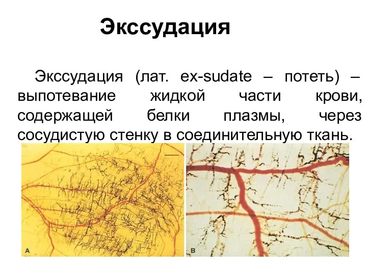 Экссудация Экссудация (лат. ex-sudate – потеть) – выпотевание жидкой части крови,