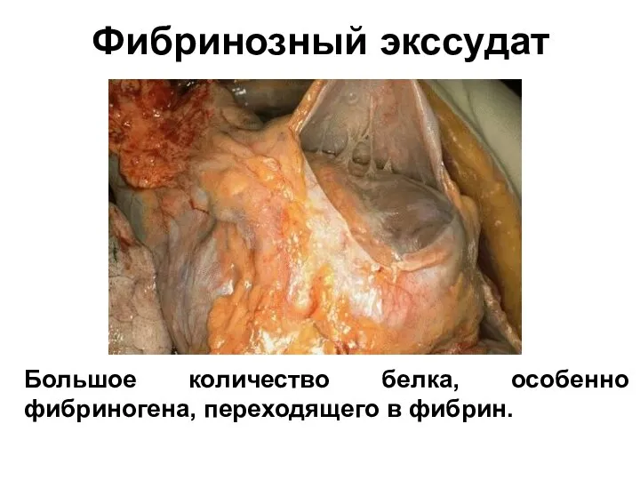 Фибринозный экссудат Большое количество белка, особенно фибриногена, переходящего в фибрин.