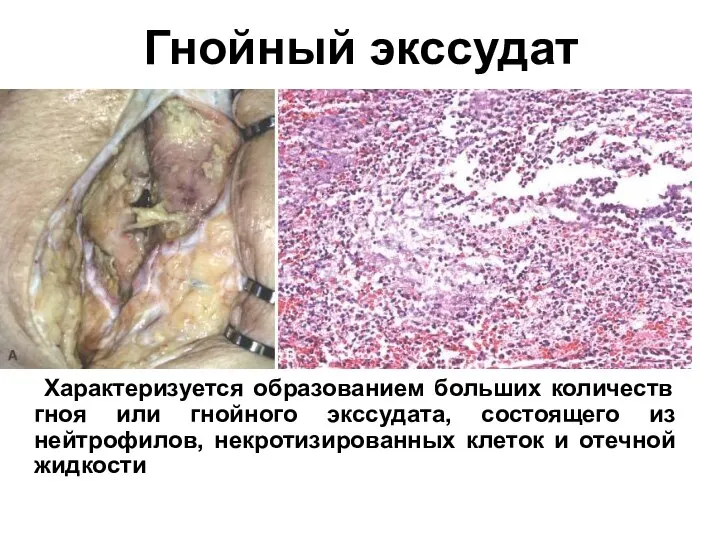 Гнойный экссудат Характеризуется образованием больших количеств гноя или гнойного экссудата, состоящего