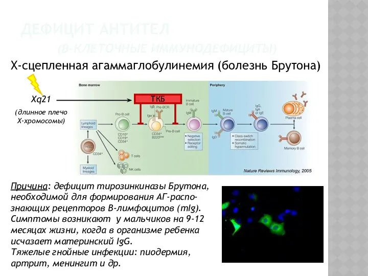 ДЕФИЦИТ АНТИТЕЛ (В-КЛЕТОЧНЫЕ ИММУНОДЕФИЦИТЫ) Х-сцепленная агаммаглобулинемия (болезнь Брутона) Причина: дефицит тирозинкиназы