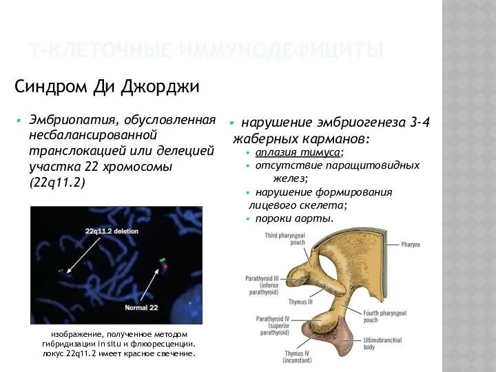 Т-КЛЕТОЧНЫЕ ИММУНОДЕФИЦИТЫ Синдром Ди Джорджи Эмбриопатия, обусловленная несбалансированной транслокацией или делецией