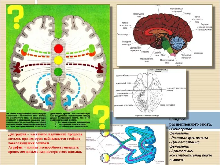 Синдром расщепленного мозга: - Сенсорные феномены - Речевые феномены - Двигательные