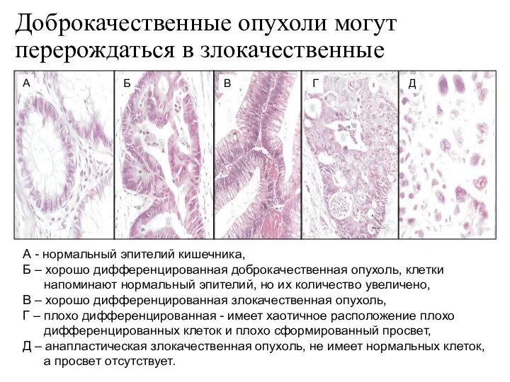 Доброкачественные опухоли могут перерождаться в злокачественные А - нормальный эпителий кишечника,