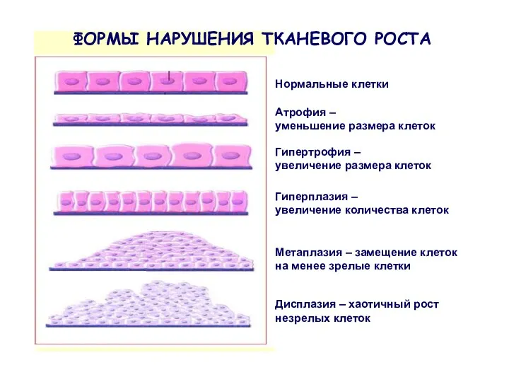 Атрофия – уменьшение размера клеток Гипертрофия – увеличение размера клеток Гиперплазия