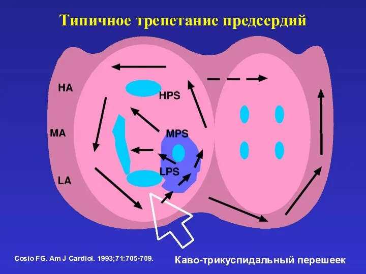 Типичное трепетание предсердий Cosio FG. Am J Cardiol. 1993;71:705-709. Каво-трикуспидальный перешеек