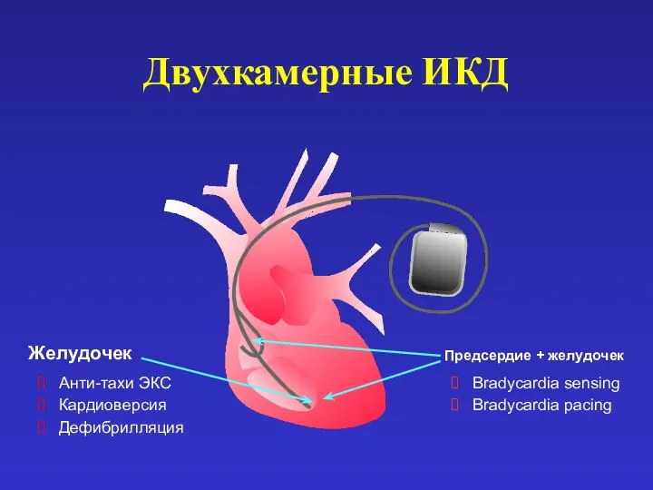 Предсердие + желудочек Желудочек Двухкамерные ИКД Анти-тахи ЭКС Кардиоверсия Дефибрилляция Bradycardia sensing Bradycardia pacing