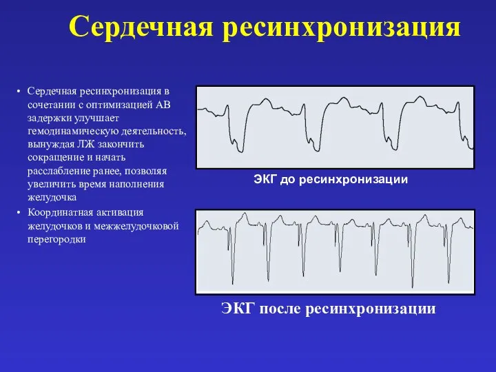 Сердечная ресинхронизация Сердечная ресинхронизация в сочетании с оптимизацией АВ задержки улучшает