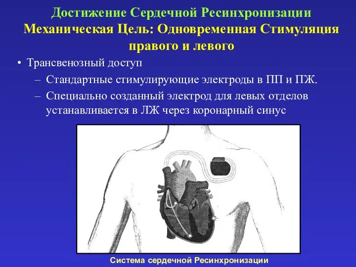 Трансвенозный доступ Стандартные стимулирующие электроды в ПП и ПЖ. Специально созданный