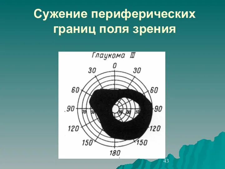 Сужение периферических границ поля зрения