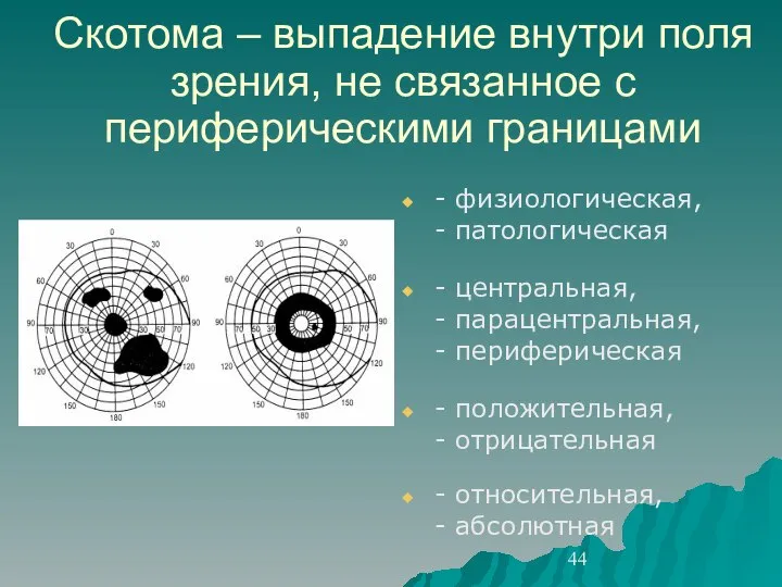 Скотома – выпадение внутри поля зрения, не связанное с периферическими границами