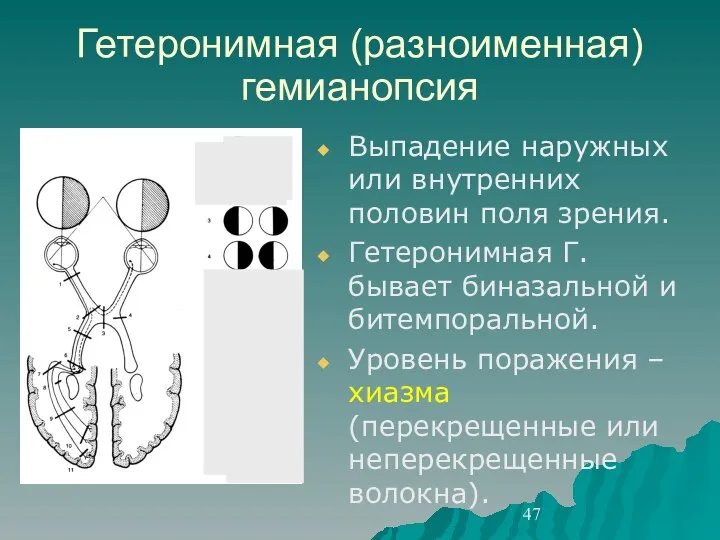 Гетеронимная (разноименная) гемианопсия Выпадение наружных или внутренних половин поля зрения. Гетеронимная