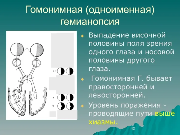 Гомонимная (одноименная) гемианопсия Выпадение височной половины поля зрения одного глаза и