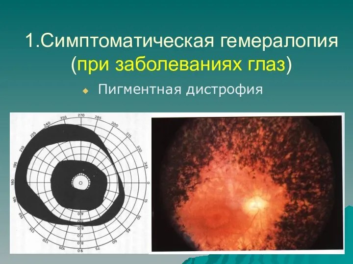 1.Симптоматическая гемералопия (при заболеваниях глаз) Пигментная дистрофия