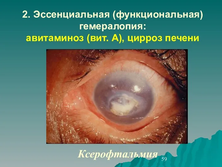 2. Эссенциальная (функциональная) гемералопия: авитаминоз (вит. А), цирроз печени Ксерофтальмия