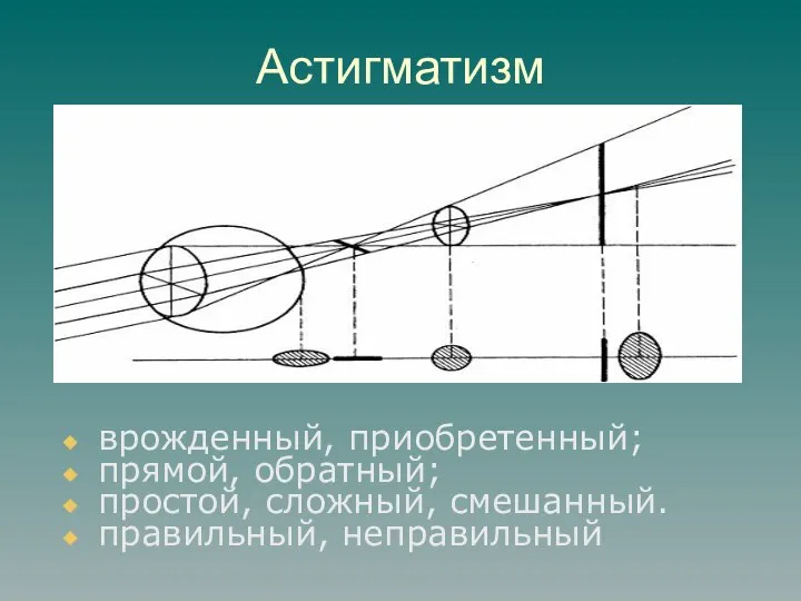 Астигматизм врожденный, приобретенный; прямой, обратный; простой, сложный, смешанный. правильный, неправильный