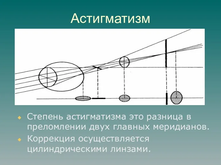 Астигматизм Степень астигматизма это разница в преломлении двух главных меридианов. Коррекция осуществляется цилиндрическими линзами.