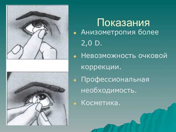 Показания Анизометропия более 2,0 D. Невозможность очковой коррекции. Профессиональная необходимость. Косметика.