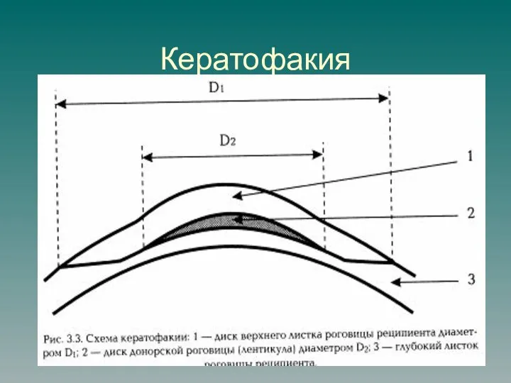 Кератофакия