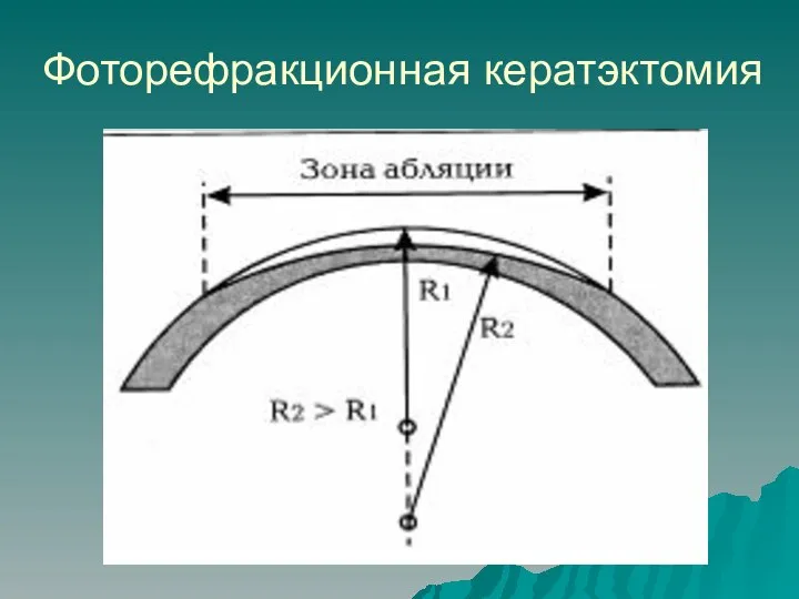 Фоторефракционная кератэктомия