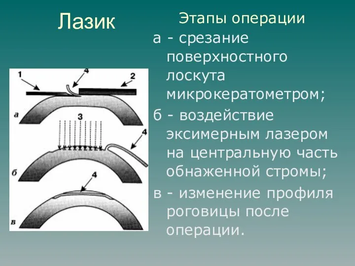 Лазик Этапы операции а - срезание поверхностного лоскута микрокератометром; б -