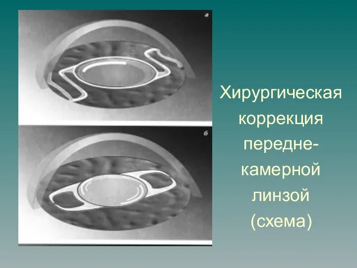 Хирургическая коррекция передне-камерной линзой (схема)