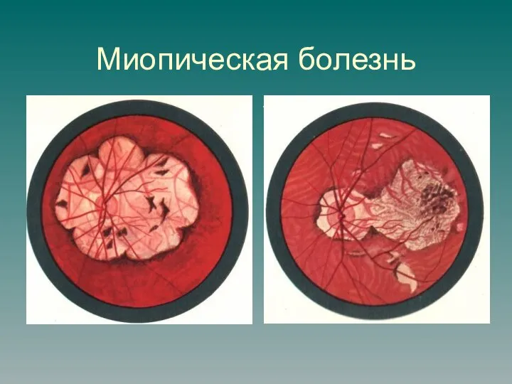 Миопическая болезнь Рисунки