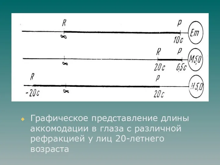 Графическое представление длины аккомодации в глаза с различной рефракцией у лиц 20-летнего возраста