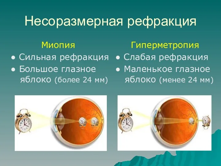 Несоразмерная рефракция Миопия ● Сильная рефракция ● Большое глазное яблоко (более