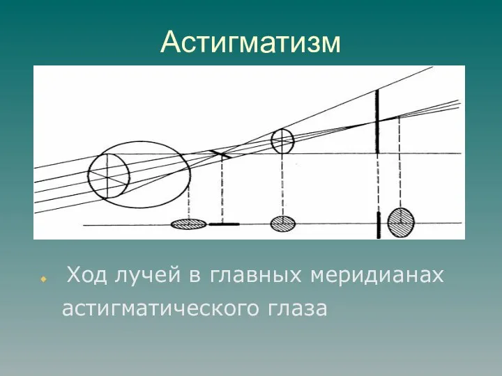 Астигматизм Ход лучей в главных меридианах астигматического глаза