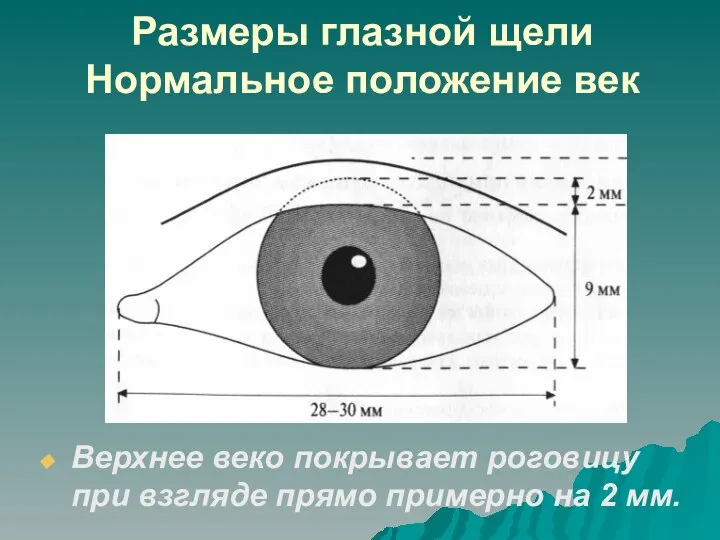 Размеры глазной щели Нормальное положение век Верхнее веко покрывает роговицу при