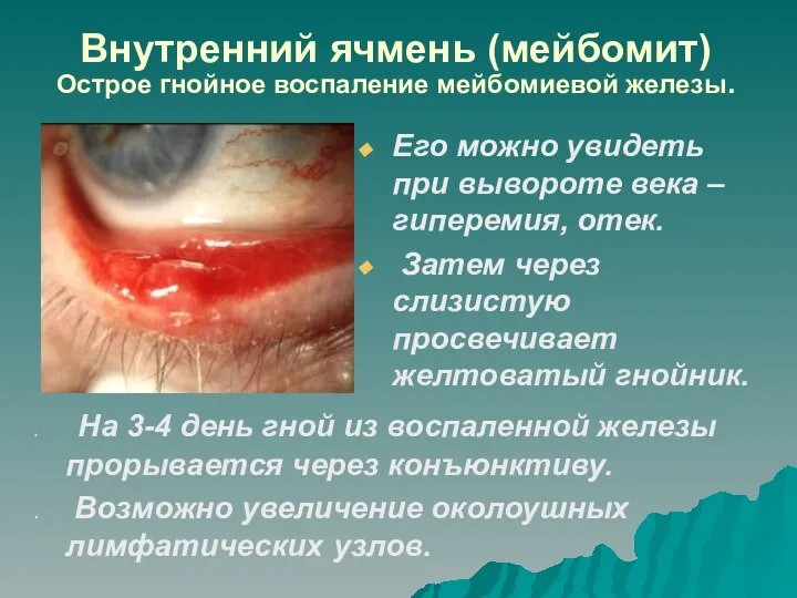 Внутренний ячмень (мейбомит) Острое гнойное воспаление мейбомиевой железы. Его можно увидеть