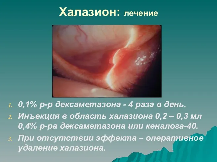 Халазион: лечение 0,1% р-р дексаметазона - 4 раза в день. Инъекция