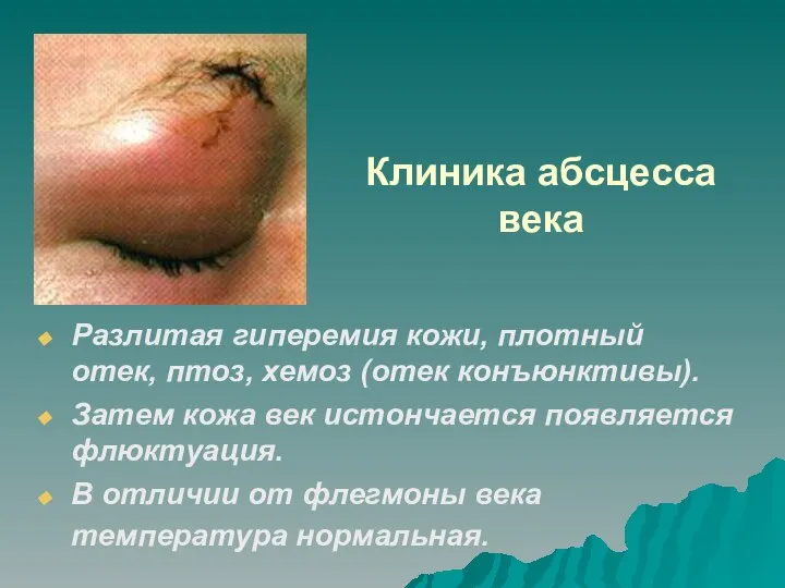 Клиника абсцесса века Разлитая гиперемия кожи, плотный отек, птоз, хемоз (отек