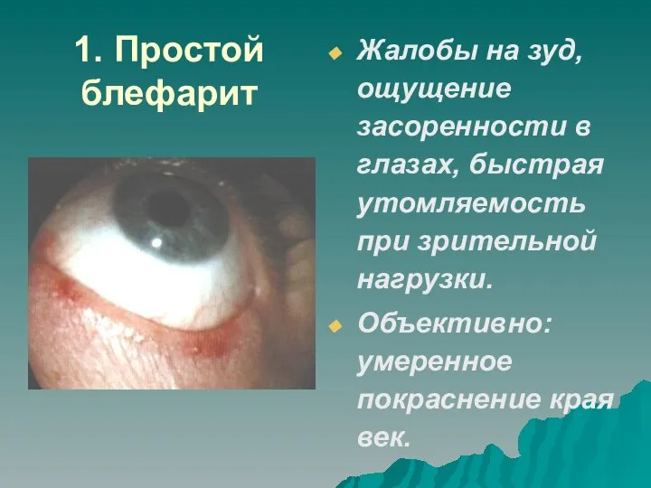 1. Простой блефарит Жалобы на зуд, ощущение засоренности в глазах, быстрая