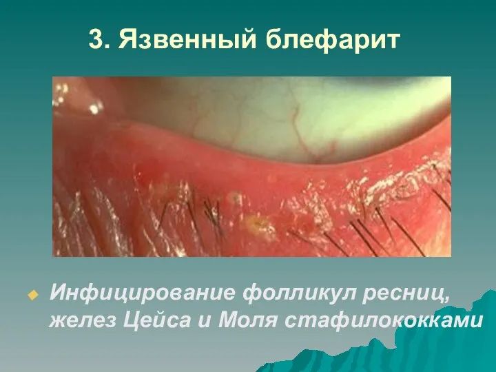 3. Язвенный блефарит Инфицирование фолликул ресниц, желез Цейса и Моля стафилококками