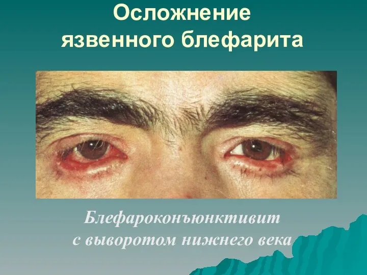 Осложнение язвенного блефарита Блефароконъюнктивит с выворотом нижнего века