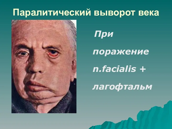 Паралитический выворот века При поражение n.facialis + лагофтальм