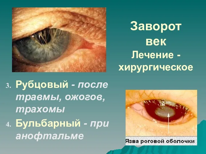 Заворот век Лечение - хирургическое Рубцовый - после травмы, ожогов, трахомы Бульбарный - при анофтальме