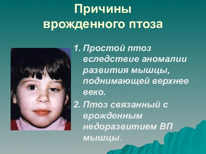 Причины врожденного птоза Простой птоз вследствие аномалии развития мышцы, поднимающей верхнее