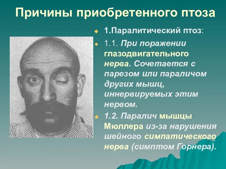 Причины приобретенного птоза 1.Паралитический птоз: 1.1. При поражении глазодвигательного нерва. Сочетается