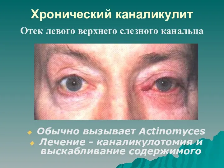 Хронический каналикулит Обычно вызывает Actinomyces Лечение - каналикулотомия и выскабливание содержимого Отек левого верхнего слезного канальца