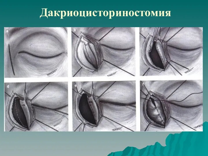 Дакриоцисториностомия Suturing of anterior flaps